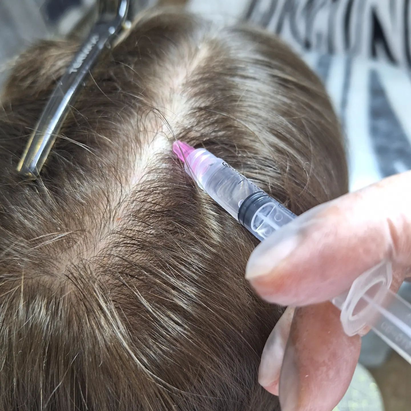 m_cosmetolog.vlg в LOOKY. #мезотерапия,#мезотерапияволос. Мезотерапия ВЧГ(воло...