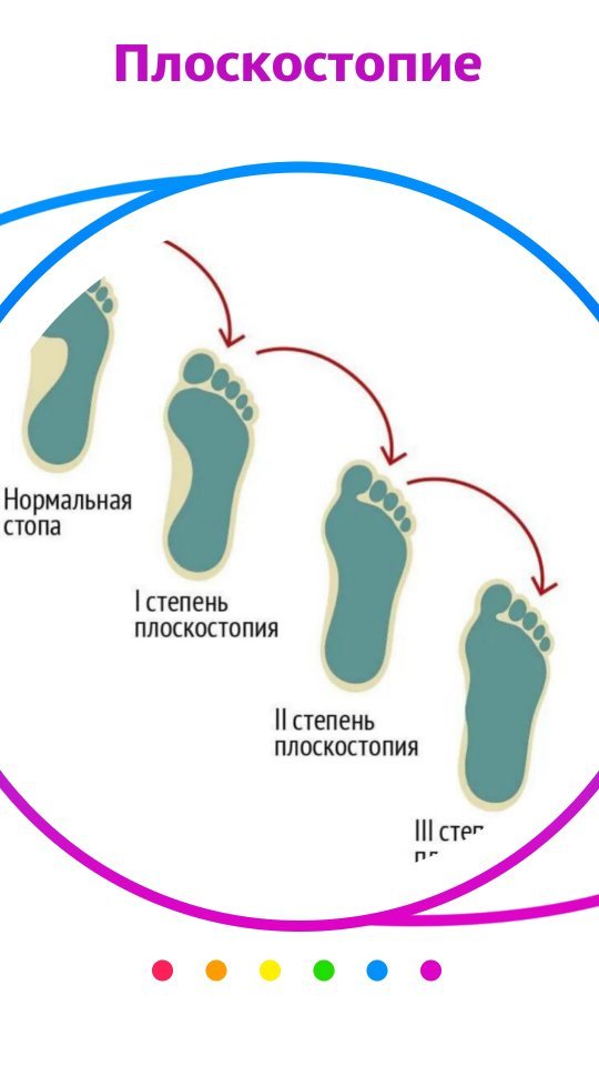 ilmira_panarina в LOOKY. #плоскостопие,#плоскостопиеудетей,#коррекцияосанки,#осанка. Плоскостопие - это с...