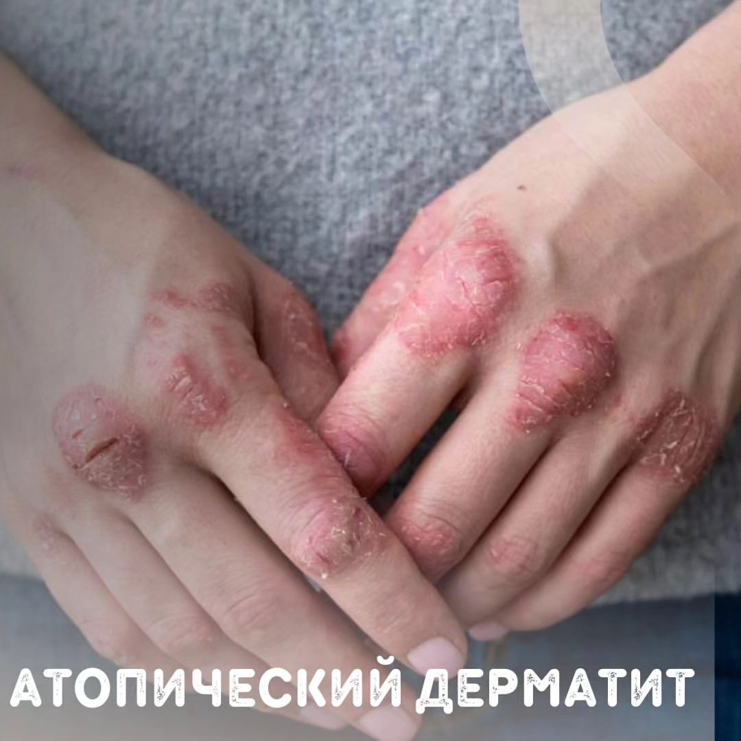 nazgul_sw_ufa в LOOKY — Нейродермит (атопический дерматит) — заболевание нервно-алле