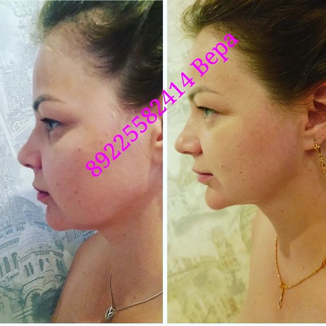 massageinoren в LOOKY. #хочупохудеть,#хочукрасивоетело,#хочумассаж,#обертываниевподарок,#выезднадом,#массажоренбург,#массаждома,#будьтездоровы,#стройнеемсверой,#ненавреди,#комплексныйподход,#всемдобра✌,#Vera,#massage,#xudeem,#stroineemveselo,#anticellulite,#мед,#массажувасдома,#доипосле,#профи,#худеемсбольшихобъёмов,#похудела,#массажорен,#талия,#результат,#люблюсвоюработу,#слюбовьюотvera,#massage,#xudeem,#марафон. Кожа подбородочно-ше...