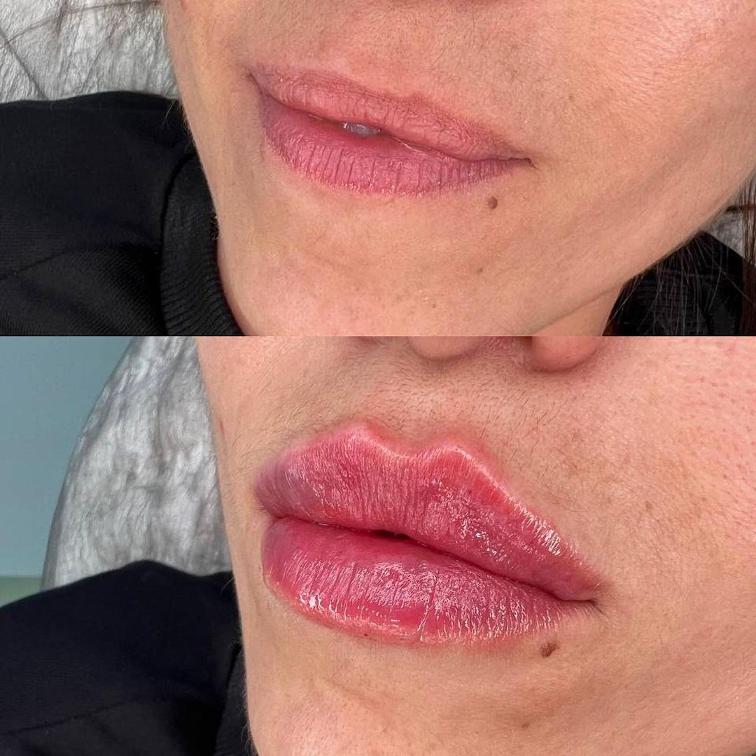 natalisher_lips в LOOKY — Два года назад в губах уже стоял филлер который уже конечно 