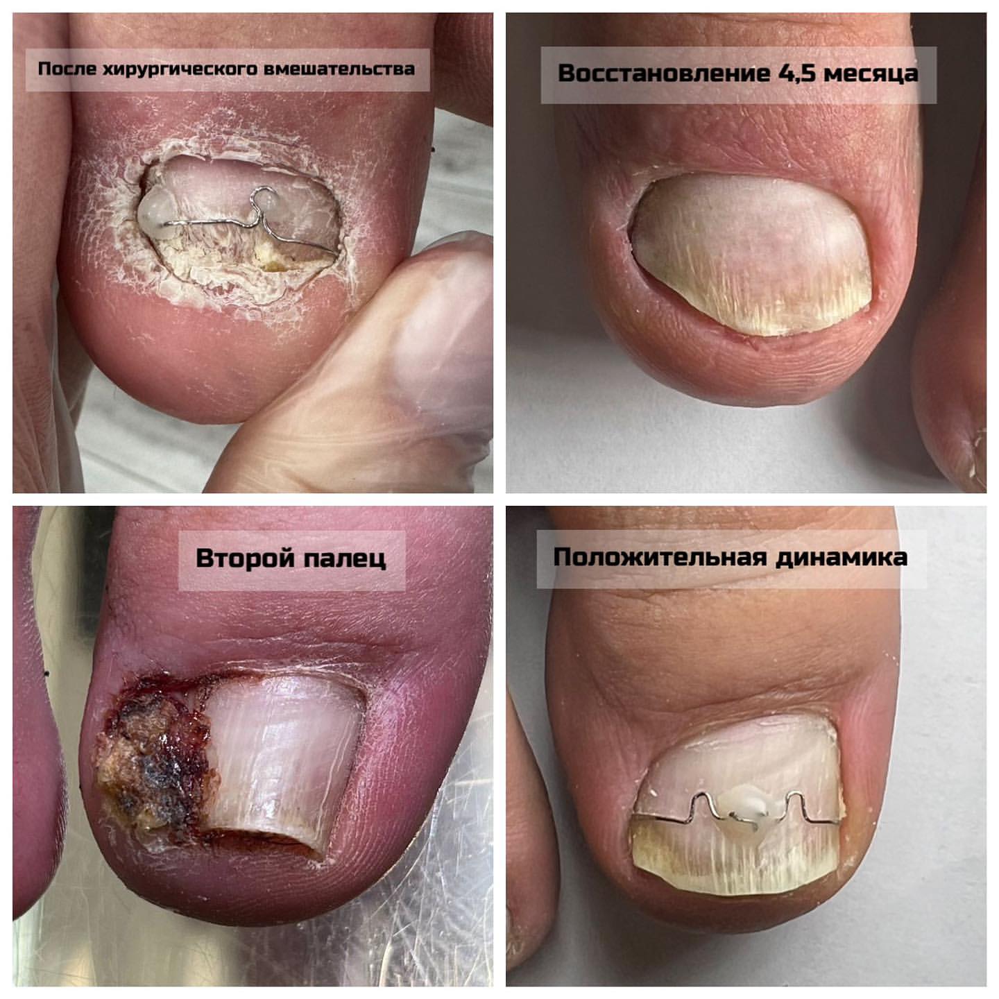 romanova_nails в LOOKY — Обращение модели в нашу Академию.
Хирургически удалена ногте