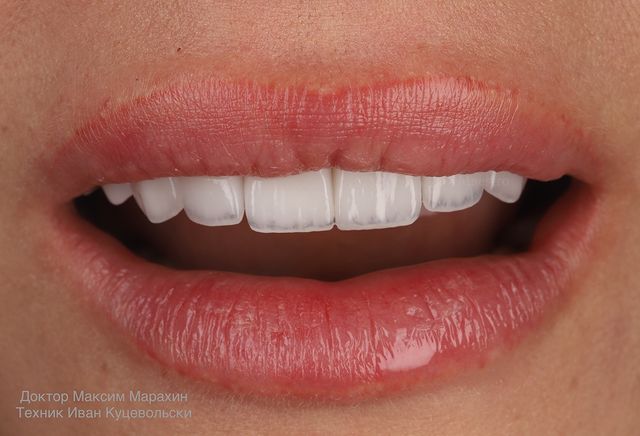 maestro_stom_snk в LOOKY. #veneers,#dentalphotographygroup,#slavyansk,#slavyansktoday,#smile,#stomatology. +1 исполненная мечта...