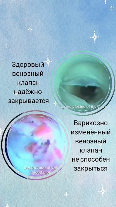 andreitempel в LOOKY. #цэт,#флеболог,#чайкины,#красноярск. Варикоз сам не исчез...