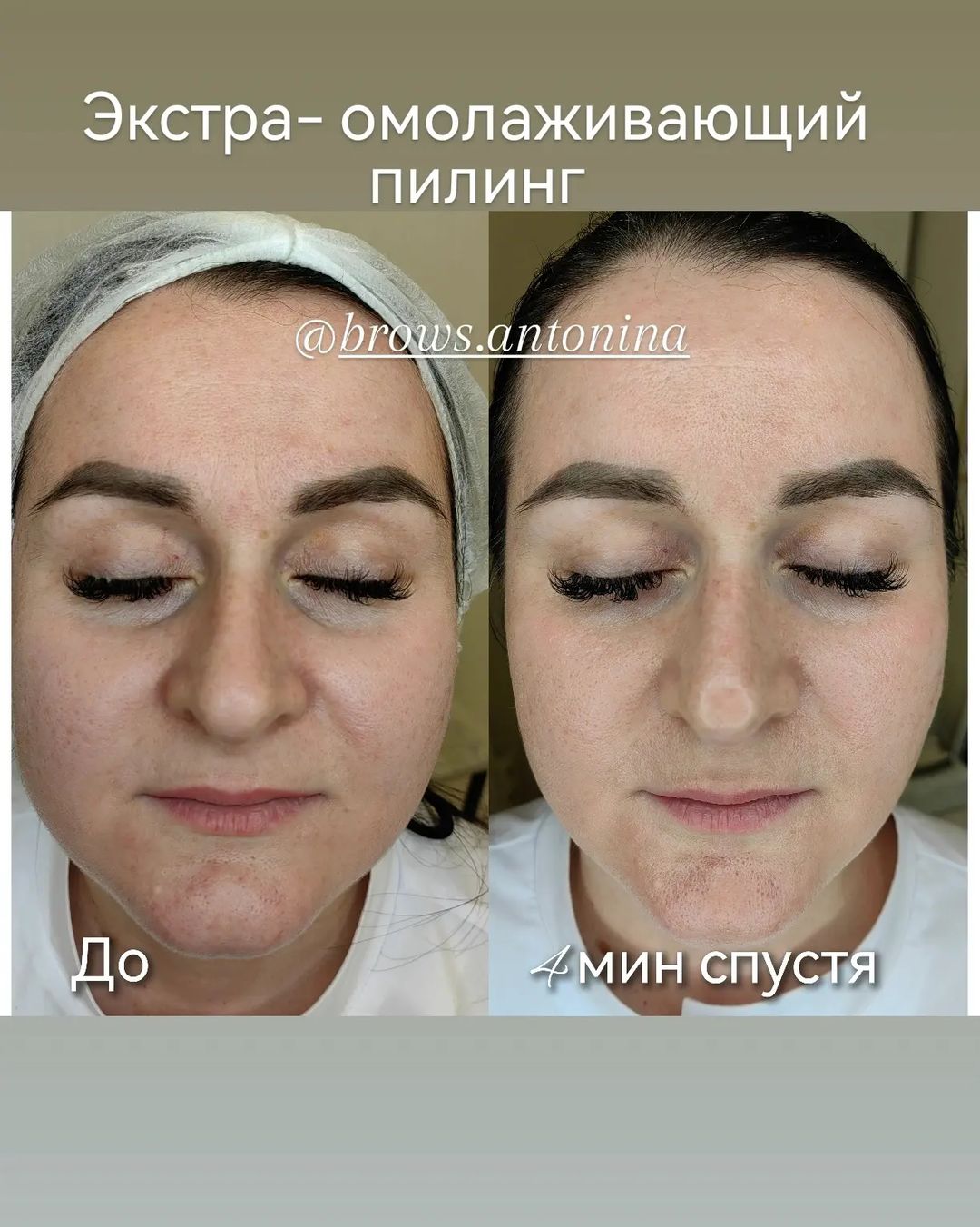 Поверхностно-срединный пилинг. Подходит для сухой и жирной кожи, поврежденной солнцем, находящейся в состоянии стресса и гипоксии, с признаками пигментации, потерей тонуса и эластичности, с морщинками, а также для кожи с нехваткой питания и кожи курильщика.
✨интенсивное обновление кожи
✨борьба с гиперкератозом
✨защита и повышение устойчивости кожи к внешней агрессии
✨противовоспалительное и сосудоукрепляющее
✨увлажнение (устранение сухости)
✨смягчение, повышение тонуса и эластичности кожи 
✨повышение иммунитета кожи
✨осветляющее (борьба с пигментацией)
✨😍 омолаживающее ( стимуляция синтеза коллагена и эластина)
✨минимизация выраженности морщин
