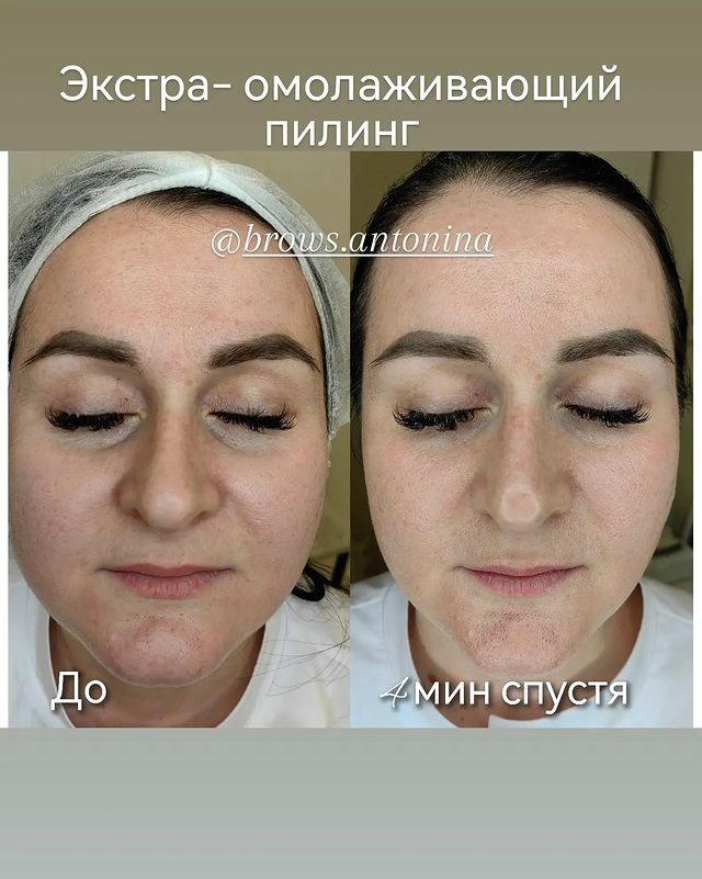 antonina.cosmetologist в LOOKY. . Поверхностно-срединн...