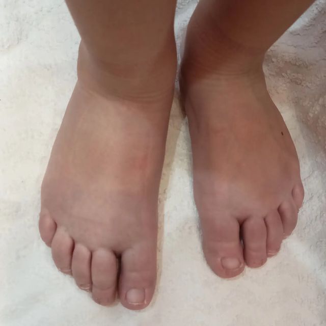 limfedema_savva в LOOKY. . Врожденная лимфедема...