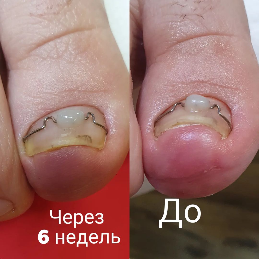 mariya_podoliski в LOOKY — Коррекционная система предназначенна для изменения формы ног