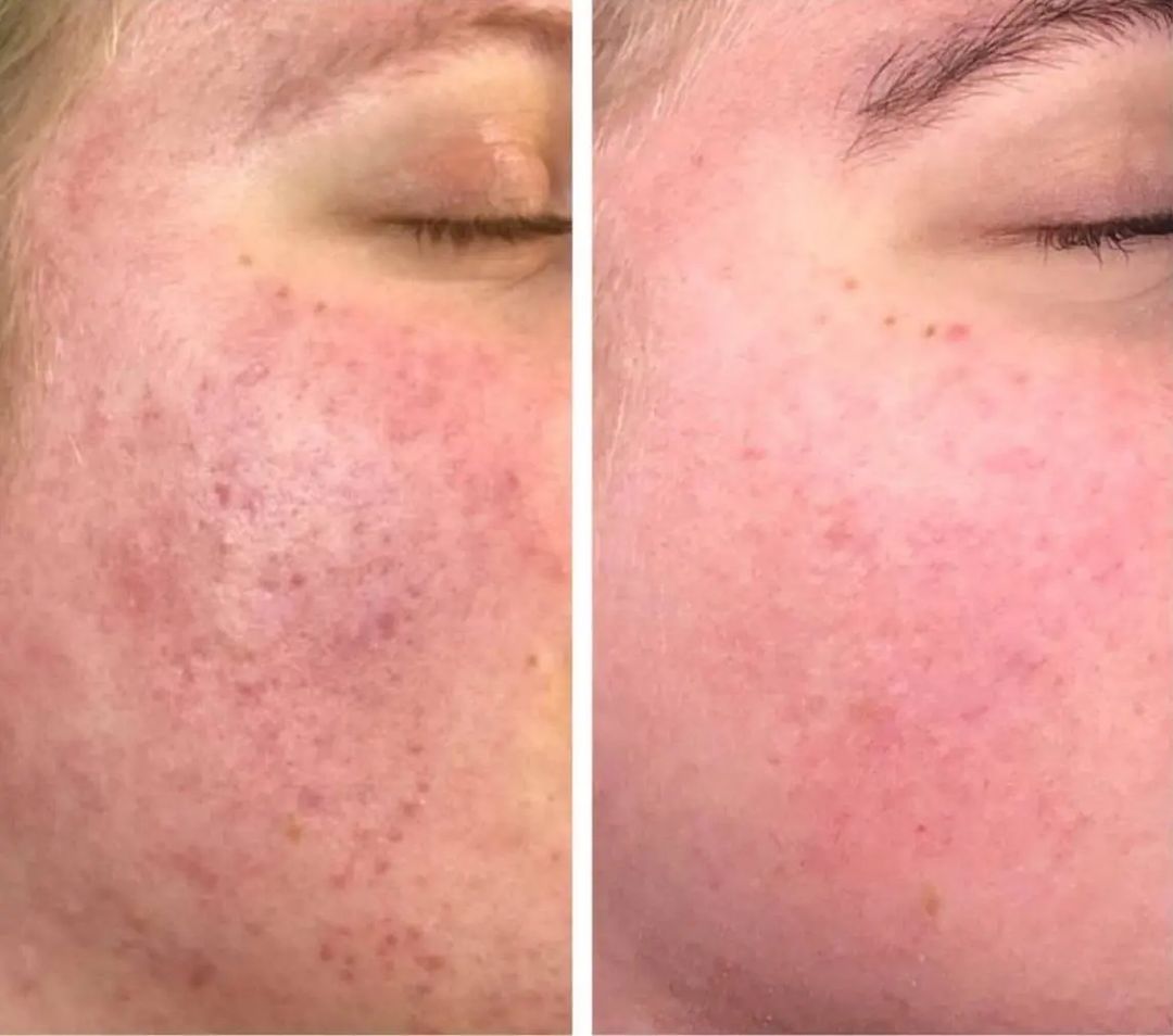 До/после 1 пилинга и домашнего ухода IMAGE Skincare 😍

Результат лечения наших коллег из Нидерландов 

Пациентке была проведена 1 процедура пилинга ORMEDIC и назначен домашний уход:
1. Очищение - Очищающее молочко с витамином С Vital C
2. Осветление - Осветляющий бустер ILUMA
3. Сыворотка - Антивозрастная сыворотка с витамином С Vital C
4. Ночной уход - Био-пептидный ночной крем ORMEDIC

Классный результат, вы согласны?