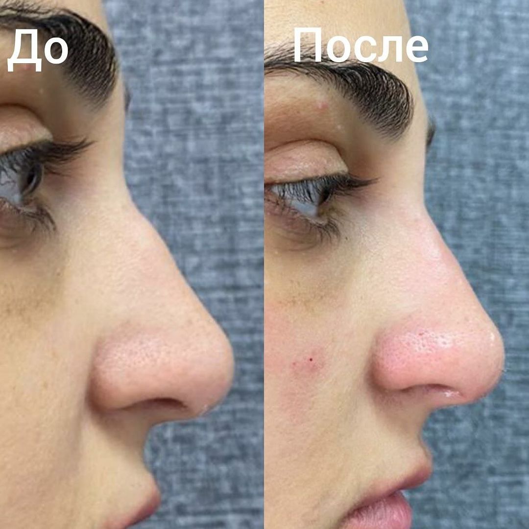 kosmetolog74_natalia в LOOKY — БЕЗОПЕРАЦИОННАЯ РИНОПЛАСТИКА ФИЛЛЕРОМ

Всего за одну процеду