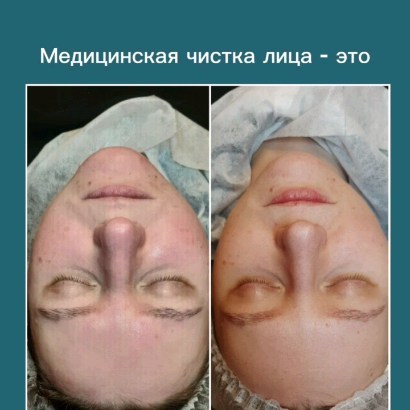 dr.mariakarpova в LOOKY. . Медицинская чистка л...