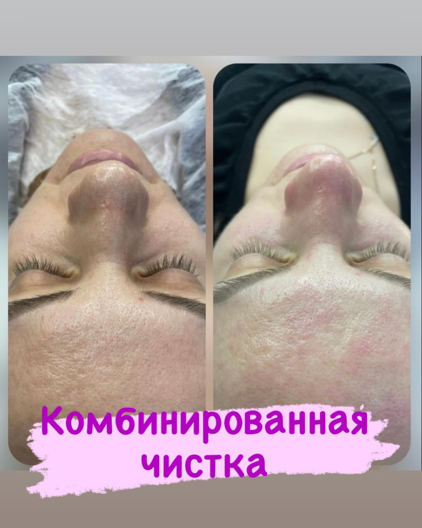 lavanda_30_astra в LOOKY. #вакуумныймассаж,#кавитацияастрахань,#похудетьастрахань,#астраханскаяобласть,#astrakhan_people,#vipastra,#rfлифтингастрахань. 🟣Комбинированная чи...