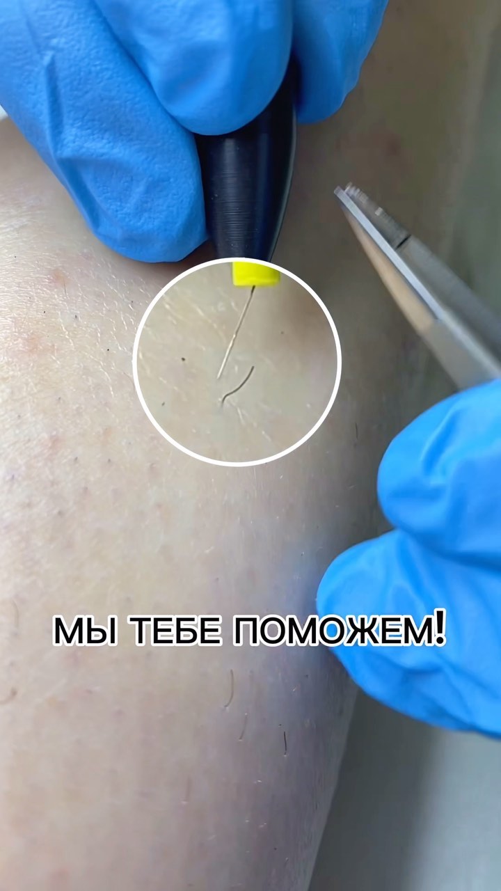bezepil_ast в LOOKY. #электроэпиляция,#электроэпиляцияобучение,#электроастрахань,#гладкаякожа,#подарок,#бонус. #электроэпиляция #эл...