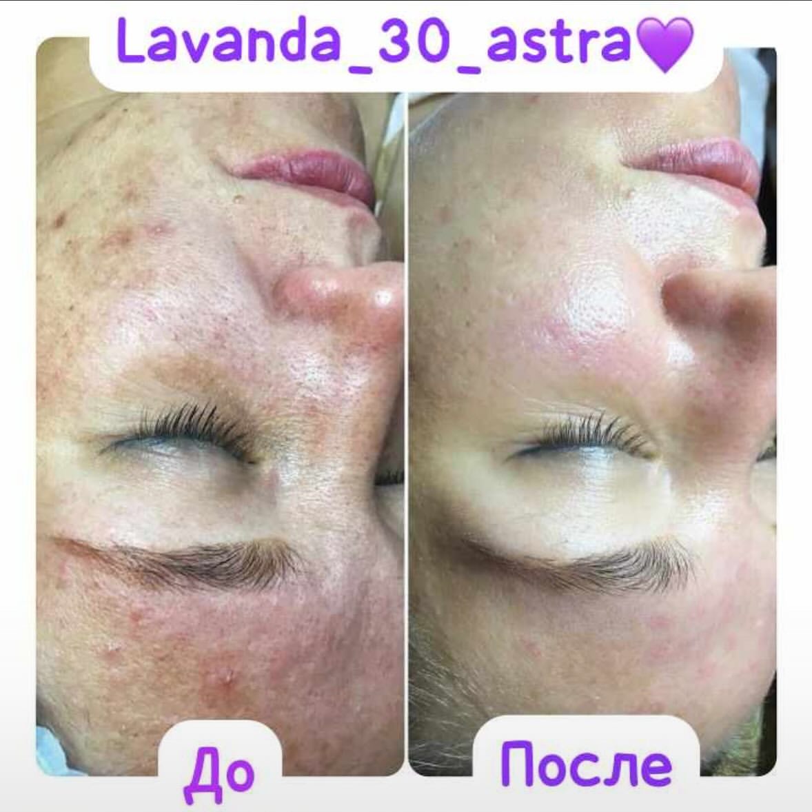 lavanda_30_astra в LOOKY. #вакуумныймассаж,#кавитацияастрахань,#похудетьастрахань,#астраханскаяобласть,#astrakhan_people,#vipastra,#rfлифтингастрахань. 💜Чистка лица 

❗️За...