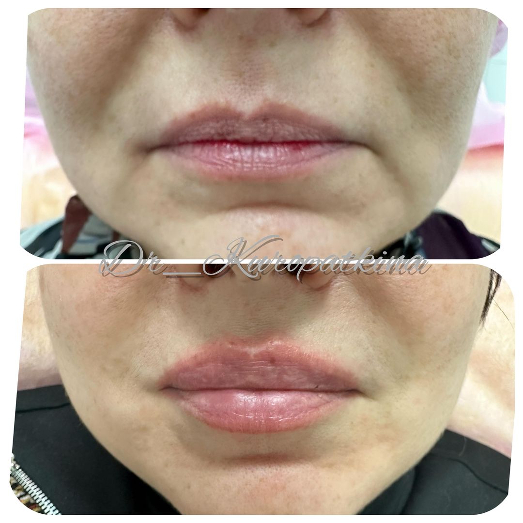 dr_kuropatkina в LOOKY — Деликатное омоложение нижней трети лица и губ с помощью филл