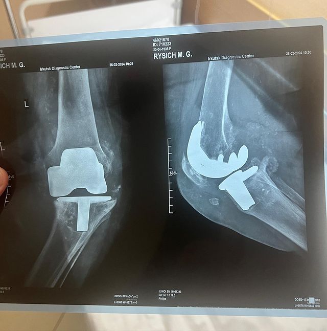 yakushevds в LOOKY. #протезколенногосустава,#kneereplacement. Сегодня поделюсь ско...