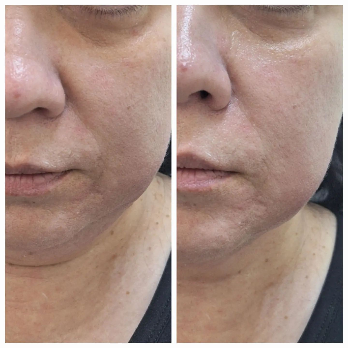 m_cosmetolog.vlg в LOOKY. #липолитик,#косметолог,#косметологволгоград,#биориветализация. Пептидный липолитик ...