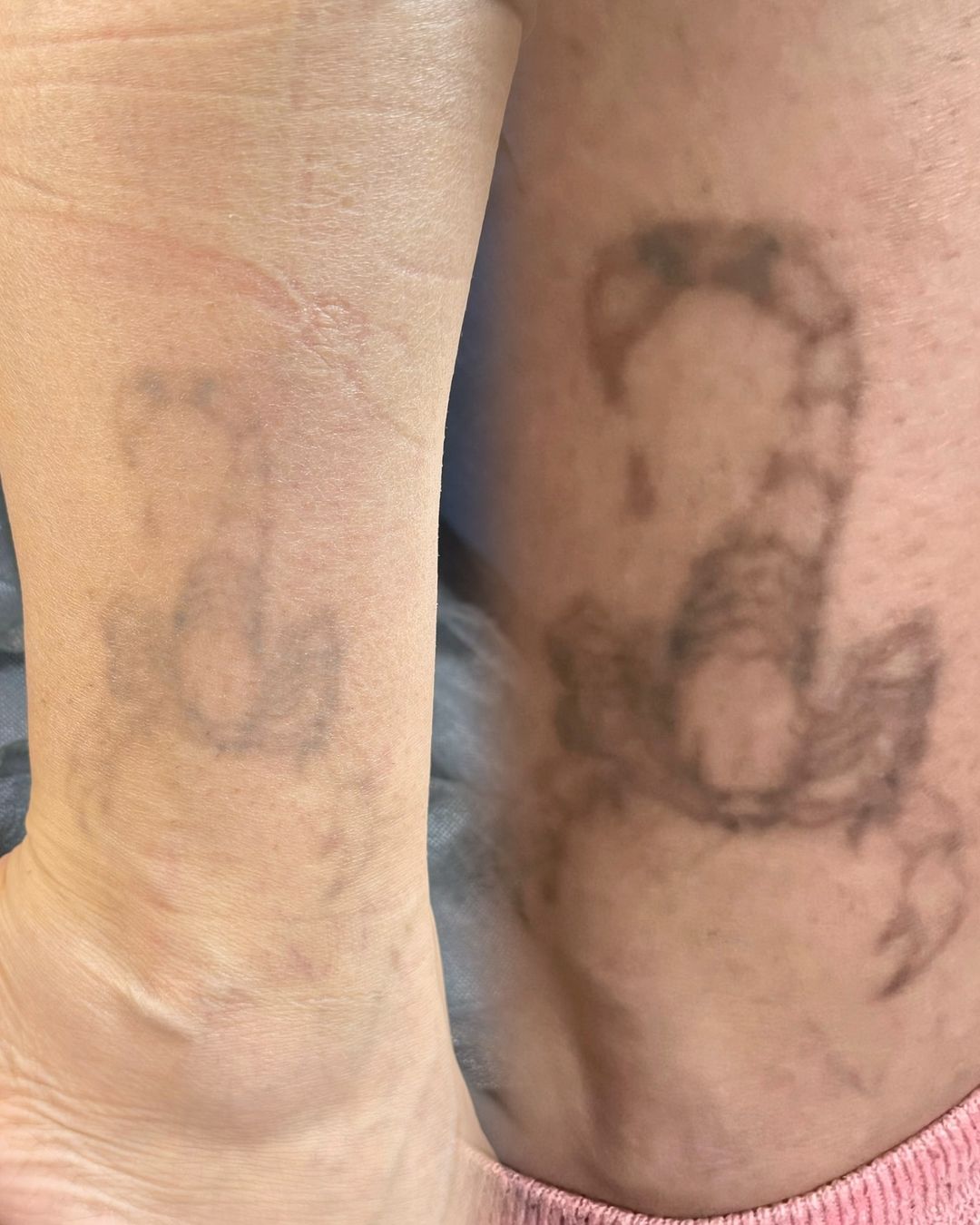 bykova_tattoo в LOOKY — Доброе утро!☀️

Хочу немного рассказать про удаление татуиро