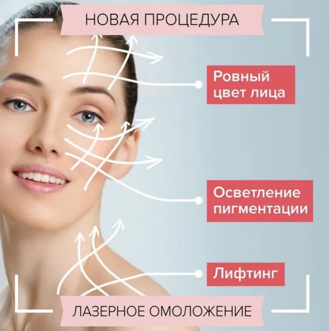 Представляю новую услугу в своём кабинете🔥 Лазерное омоложение🔥 Что же это такое и как происходит сама процедура? Сразу хочу отметить, что это совершенно безболезненно и даже очень приятно😄 Лазерное омоложение помогает бороться с такими проблемами, как:
✅ морщины; 
✅ пигментация; 
✅ акне и постакне;
✅ миллиумы; 
✅ неровности кожи; 
✅ расширенные поры.
Лазерное омоложение достигается длиной волны лазерного излучения, которая проникает вглубь кожи, к волокнам коллагена и эластина. Верхние слои кожи при этом не повреждаются. Основной эффект от лазерного омоложения - уплотнение волокон дермы, в результате кожа подтягивается, а морщины разглаживаются. Это полностью атравматическая процедура. Инфракрасный импульс стимулирует работу ваших собственных фибробластов, которые начинают активно синтезировать коллаген.
Таким образом, качественный вид кожи начинает улучшаться естественным путем: разглаживаются мелкие морщинки, сужаются поры, выравнивается цвет лица, кожа становится более упругой и подтянутой.
Застойные пигментные пятна становятся светлее. Лицо приобретает отдохнувший, свежий и здоровый вид. Чем более зрелый у вас возраст и чем более выражены морщины, тем результат от процедуры будет более заметным, однако омоложение на диоде вполне применимо и как профилактическая процедура ранних признаков старения. Это запускает процессы естественного самоомоложения. Конечный результат проявляется в течение 6-12 месяцев после прохождения полного курса. Эффект не моментальный, так как мы активируем фибробласты, которые после завершения всех процедур продолжают работать, тем самым обновляется коллагеновая структура - организму требуется на это время. Но уже сразу после первой процедуры мы видим положительный результат.
За счет чего происходит отбеливание кожи? Во время процедуры инфракрасный импульс воздействует на скопление меланоцитов, которые вырабатывают пигмент меланин. Меланоциты концентрируются на верхнем (базальном) слое кожи, за счет чего и происходит пигментация. Под воздействием лазера эти клетки начинают постепенно разбиваться и дробиться.
Дальше👇🏼👇🏼👇🏼👇🏼👇🏼👇🏼