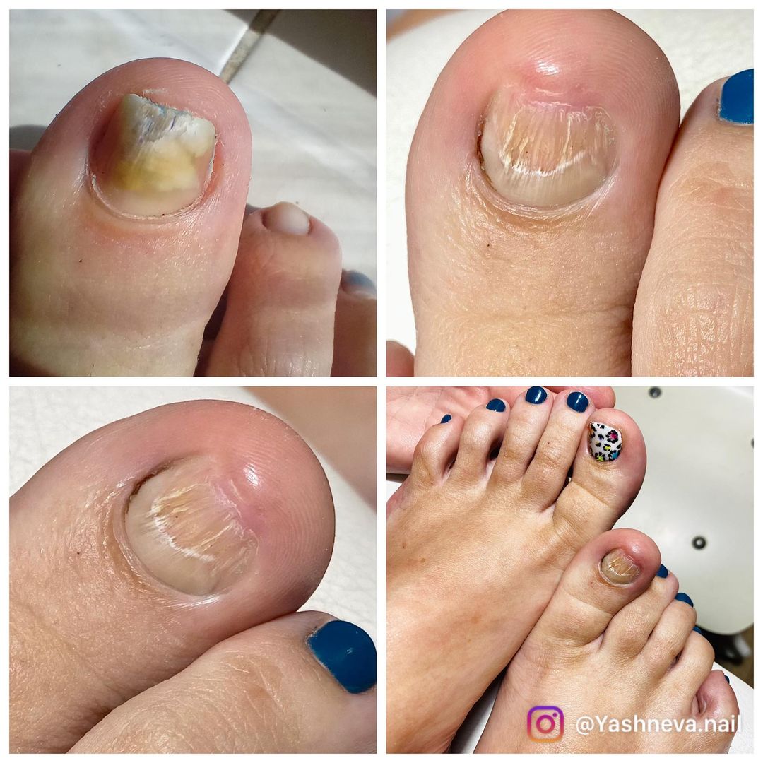 yashneva.nail в LOOKY — Главное - Здоровье! Ноготок зачистили, красоту сотворили !) 