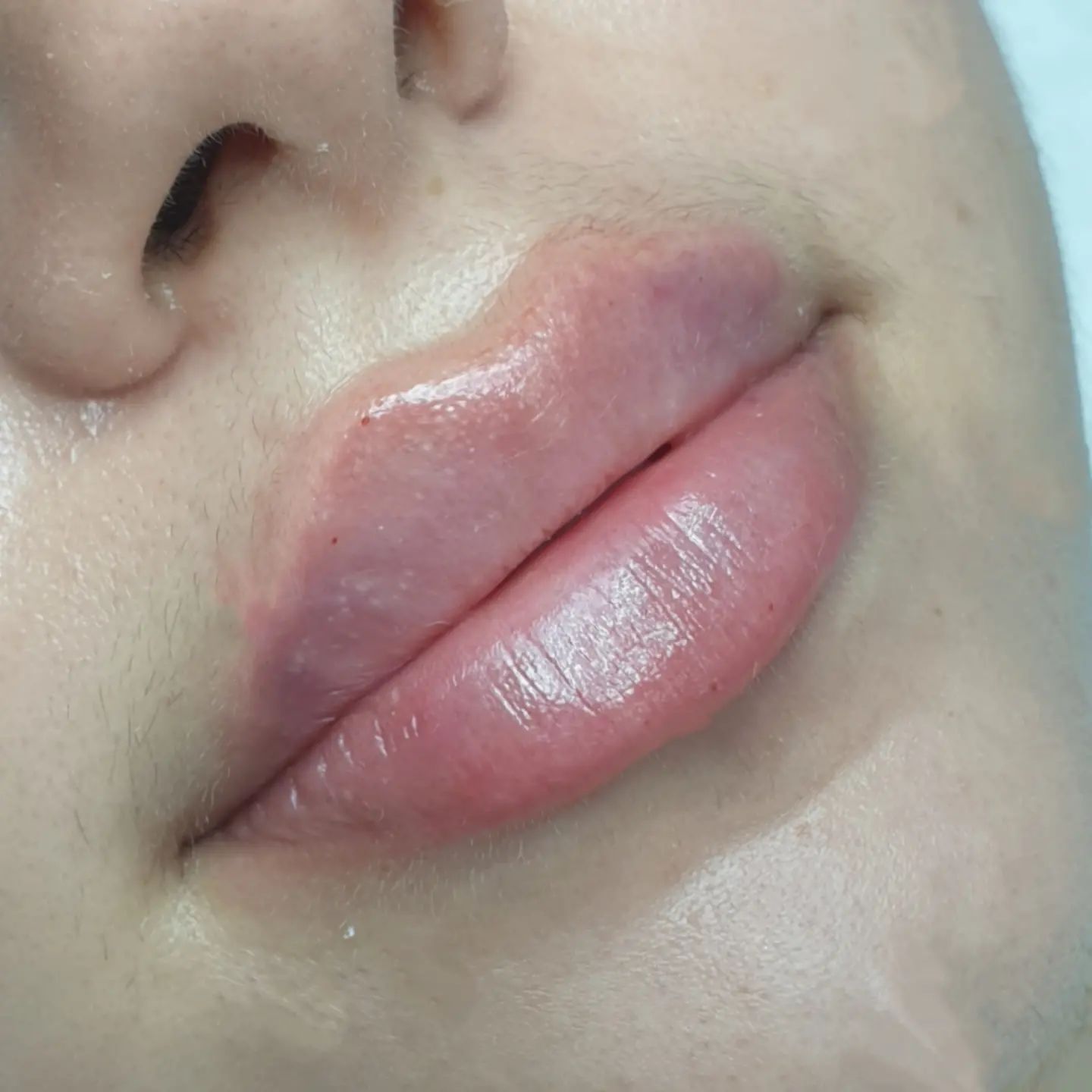 beautiful_skin_vl в LOOKY. #чисткалицавладивосток,#увеличениегубвладивосток,#ботоксвладивосток,#лифтинглицавладивосток,#коллагенвлаливосток,#когиvdk. Контурная коррекция ...