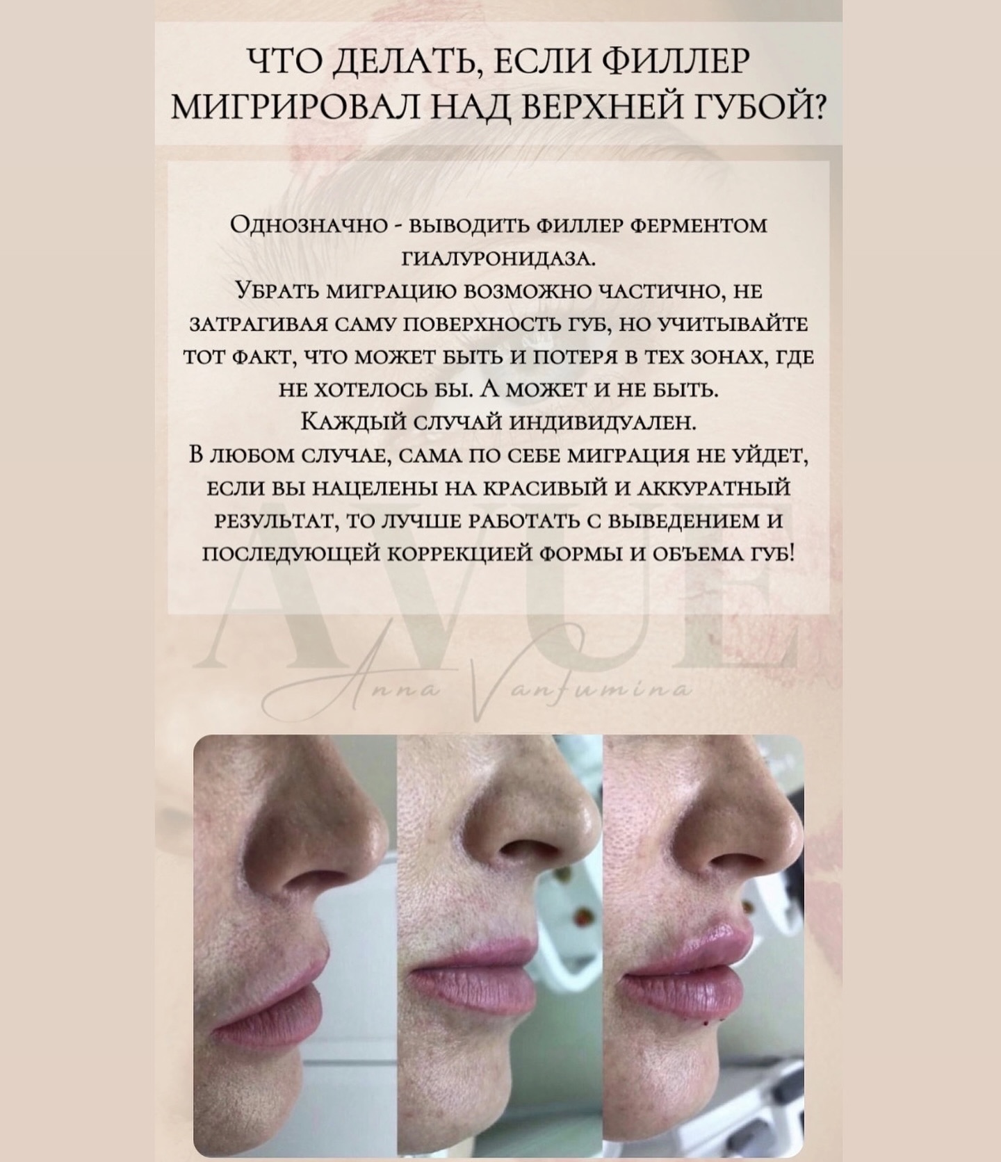 Распространенный вопрос о миграции филлера в так называемые «гиалуроновые усы». Почему и что делать?

https://t.me/avue33

https://instagram.com/avue.aesthetic?igshid=OGQ…

https://vk.com/avue33

#контурнаяпластика #рфлифтинг #микроигольчатыйрф #микроигольчатыйrf #микроигольчатыйrfмуром #кавитация #кавитациямуром #липосоникс #липосониксмуром #смас #smas #смаслифтинг #смаслифтингмуром #микротокимуром #элос #омоложение #элосмуром #прессотерапия #миостимуляция  #губы #увеличениегуб #ботокс #биоревитализация #электроэпиляция #мезотерапия #липолитики #косметолог #косметологмуром #коррекцияфигуры #коррецияфигурымуром