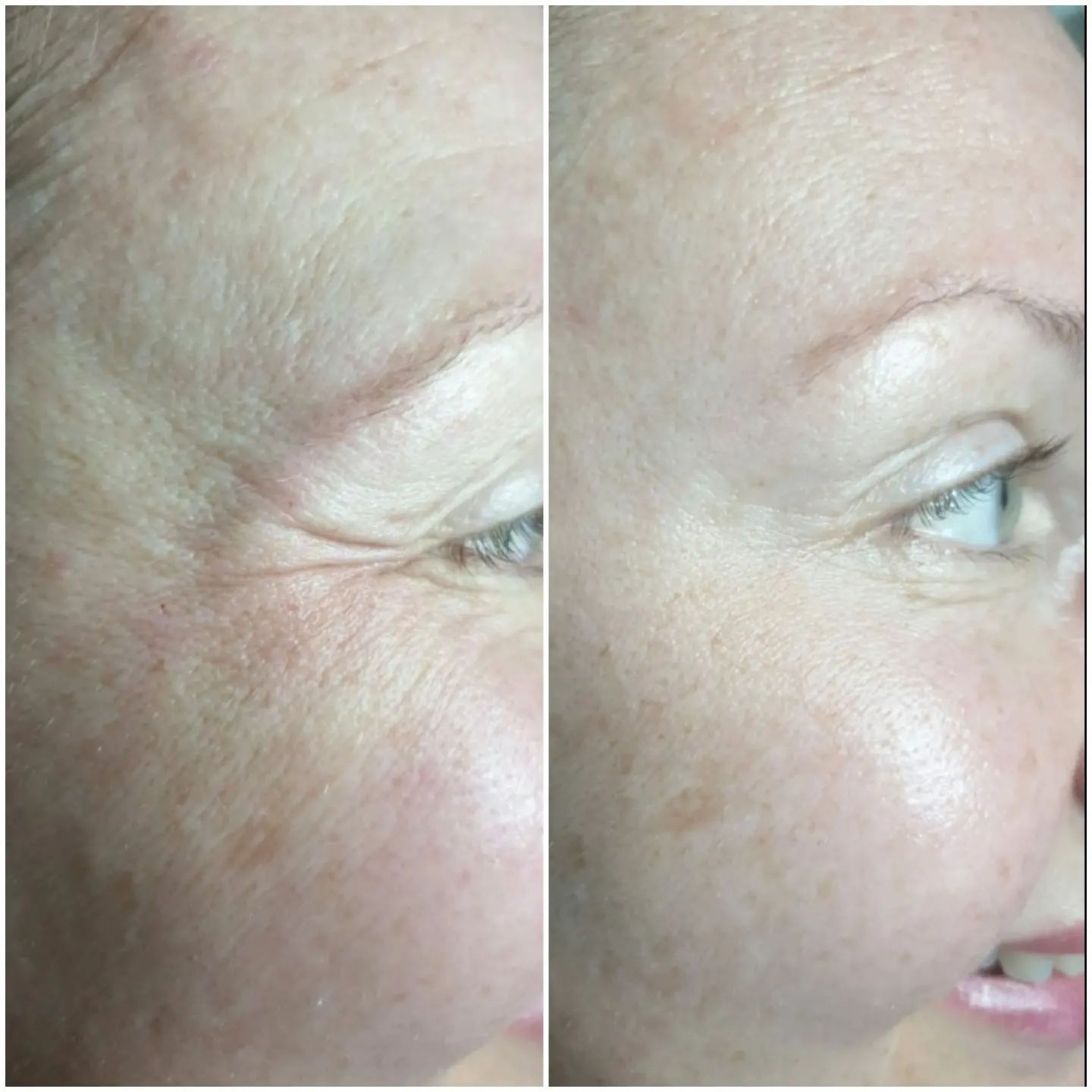 beautiful_skin_vl в LOOKY. #релатокс,#мимическиеморщины,#когивл,#пилингвл,#губывладивосток,#губывладивосток💋💋💋,#экзосомывладивосток. Релатокс – первый ро...
