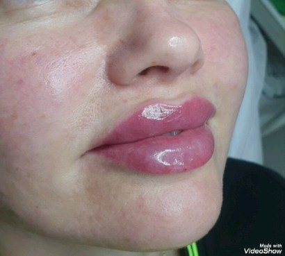 beautiful_skin_vl в LOOKY. #губывладивосток,#губывладивосток💋💋💋,#контурнаяпластикавладивосток,#подтяжкалицанитямивладивосток,#коррекцияподбородкавл,#реатоксвладивосток,#биоревитализациявладивосток,#мезонитивладивосток. #губывладивосток 
#г...
