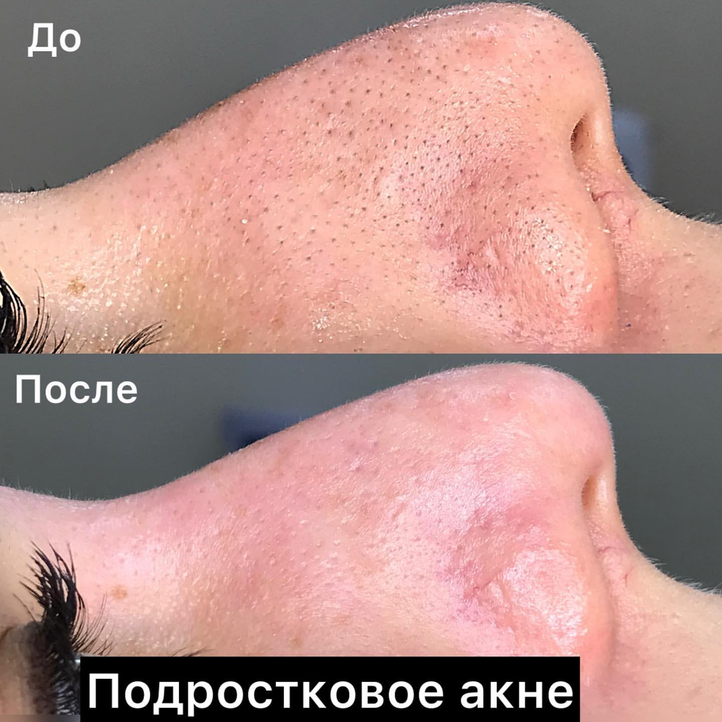cosmetolog_verba в LOOKY. #чисткалица,#уходзакожей,#акнеподростков,#косметологставрополь,#косметолог126,#лечениеакне,#акне,#подростковыйуход,#косметология. ПОДРОСТКОВОЕ АКНЕ
⠀
...