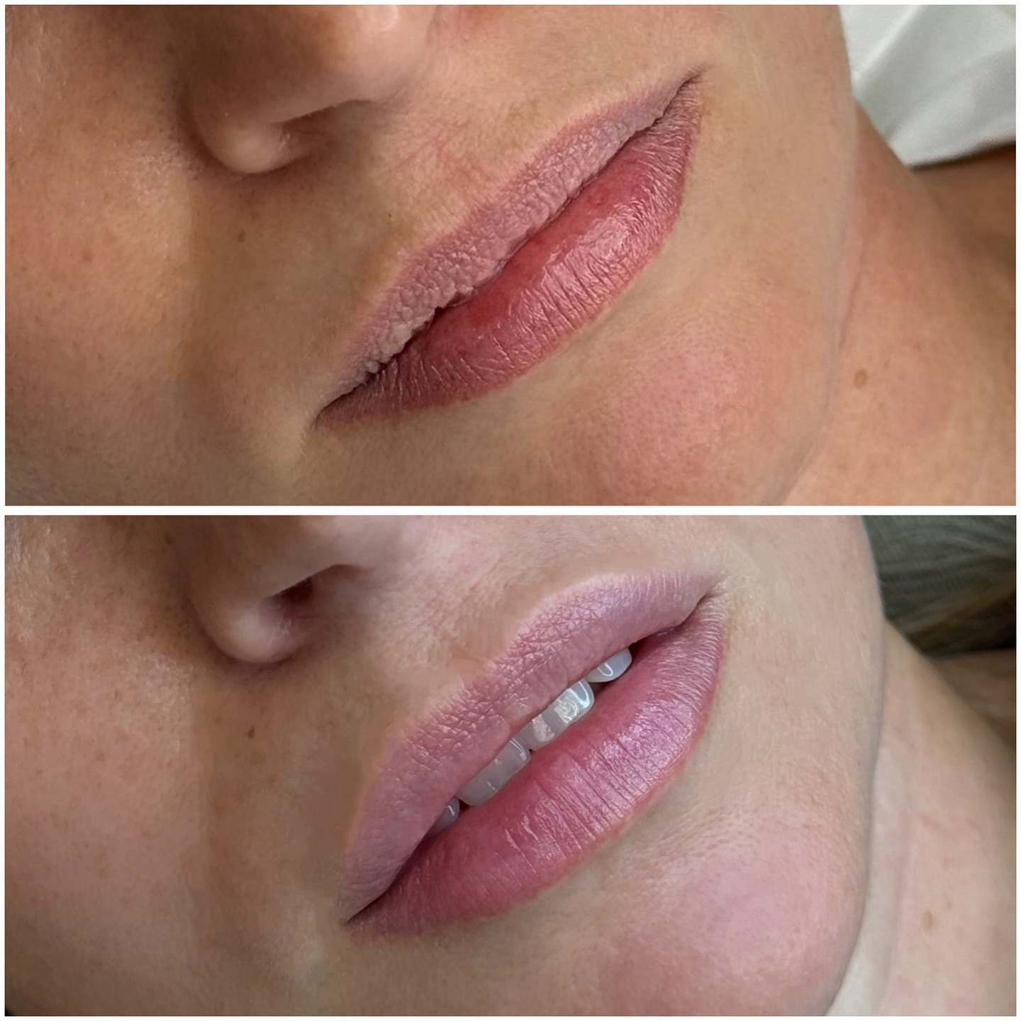 esthetic.face.ekb в LOOKY. #контрунаяпластикагуб,#контурнаяпластикагубекб,#губы,#губыекб,#косметология,#косметологекб,#уходзасобой. 👄Зажившие губы в на...