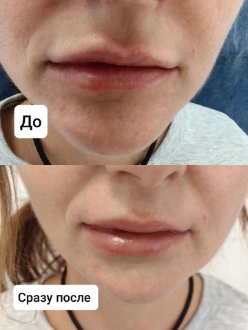 Афина Эстет в LOOKY. #АфинаЭстеткрд#stylagemКраснодар#гиалуронидазакрд#Favori,#revistrongафинаэстет#выведениегиалуроновойкислоты#FavoriPLLAHAкраснодар#УходЗаСобой. Растворение филлера:...