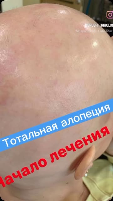 brush_triholog в LOOKY. ###,###,###,###,#Трихолог,#Алопеция,#ЗдоровьеВолос,#Самопринятие,#ПомощьСпециалиста,#выпадаютволосычтоделать,#выпадаютволосы,#лечениеволосновосибирск. **✨ Тотальная алопец...