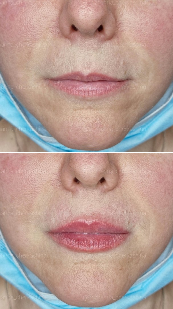 ⠀
Контурная #ПластикаГуб 👄
До и сразу после✨
Препарат #BeloteroLipsContour 💉
⠀
#ВрачКосметолог #Жанна_Черкашина 💋
⠀
📱+7(981) 748-59-57(Viber, What’s app, iMessage,sms, звонок) #увеличениегубспб  #контурнаяпластикаспб #косметологспб #контурнаяпластикагубспб #пухлыегубкиспб  #красивыегубыспб  #сделатьгубыспб #спб #питер  #хочугубыспб #увеличениегубпитер #губыспб  #длт  #длтспб #увеличениегубмосква #губымск  #сделатьгубымосква #spb #увеличениегубмск 
#belotero #beloterolips #белотеро #белотеролипс  #beloterofiller  #beloterocontour #губы_beloterocontour
