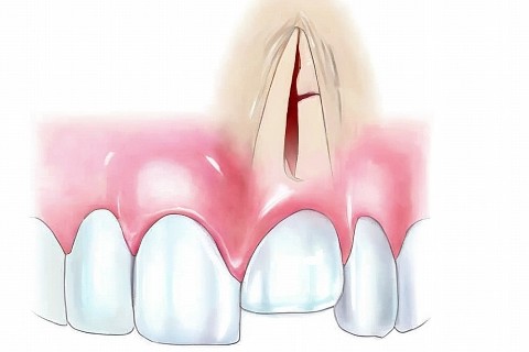 6stomat.clinic в LOOKY. . Интрузия зуба ("вкол...