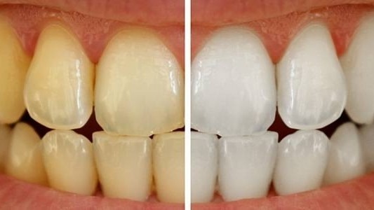 6stomat.clinic в LOOKY — Почему темнеют зубы? Потемнение зубов может иметь множество 