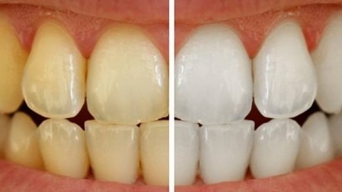 6stomat.clinic в LOOKY. . Почему темнеют зубы?...