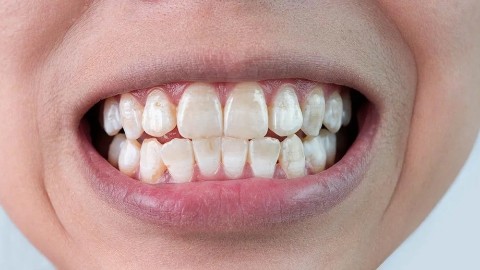 6stomat.clinic в LOOKY. . Некариозные поражени...