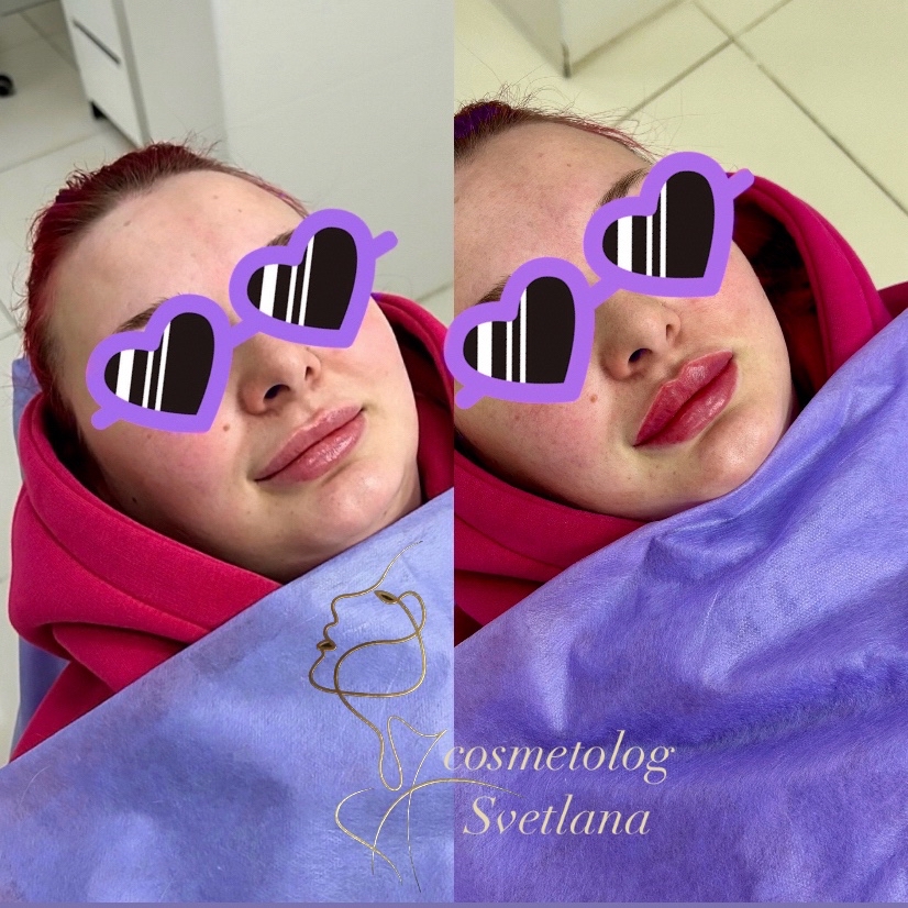 Наши #зажившие_губки_Svetlana_G и после новой процедуры❤️

✔️ Длительность процедуры: 40 мин
✔️ Основной отёк: 3-5 дней 
✔️ Анестезия входит в стоимость 
✔️ Реабилитация и восстановление после процедуры 2 недели

___________________________

🫦 𝓴𝓸𝓼𝓶𝓮𝓽𝓸𝓵𝓸𝓰 𝓢𝓿𝓮𝓽𝓵𝓪𝓷𝓪 𝓖𝓸𝓻𝓲𝓪𝓮𝓿𝓪 🫦

#косметологснежинск #косметологчелябинск #красота #услугикосметолога #снежинск #челябинск #увеличениегуб #ботокс #увеличениегубчелябинск #ботоксчелябинск #увеличениегубснежинск #ботоксснежинск #услугикосметологачелябинск #услугикосметологаснежинск  #губкибантиком #губыГоряева #губычелябинск #губыснежинск #губыГоряевой #увеличениегубчелябинск #увеличениегубснежинск #ботоксчелябинск #ботоксснежинск #косметологиячелябинск #косметологияснежинск #врачкосметолог #врачкосметологчелябинск #врачкосметологснежинск #врачкосметолог #плоскиегубы #красивыегубы #коррекциягуб