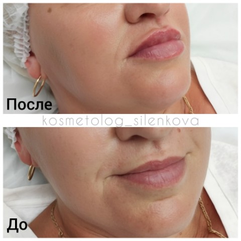 kosmetolog_silenkova в LOOKY. #челябинсккосметолог#троицккосметолог#челябинскуслуги#троицкуслуги#косметологчелябинск#косметологюжноуральск#биоревитализация#биоревитализациягуб. «Биоревитализация — ...