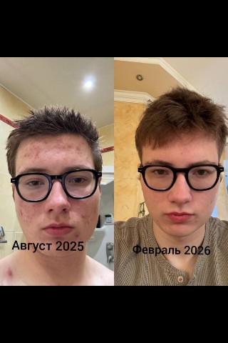 Азиза в LOOKY. . Акне средней степени...