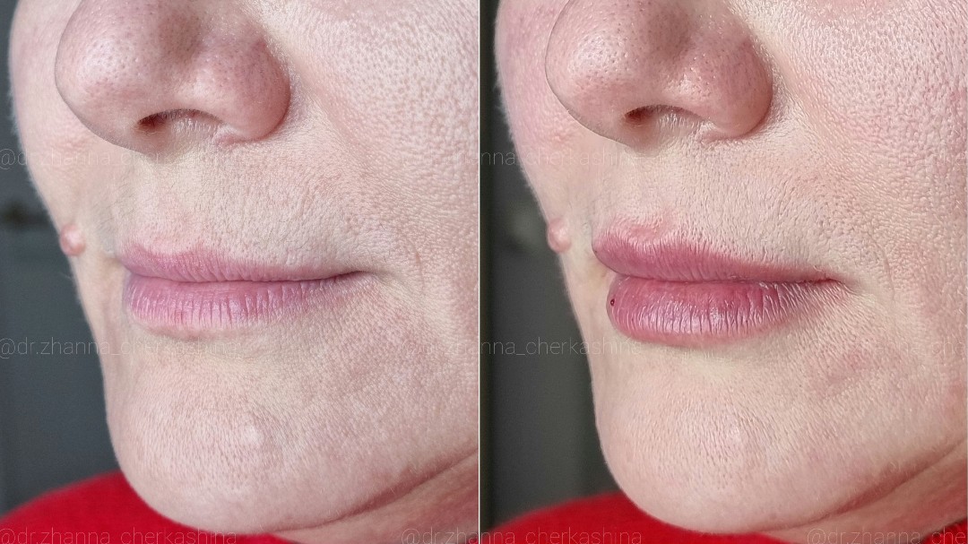 ⠀
Контурная #ПластикаГуб 👄
До и сразу после✨
Препарат #BeloteroLipsContour 💉
⠀
#ВрачКосметолог #Жанна_Черкашина 💋
⠀
📱+7(981) 748-59-57(Viber, What’s app, iMessage,sms, звонок) #увеличениегубспб  #контурнаяпластикаспб #косметологспб #контурнаяпластикагубспб #пухлыегубкиспб  #красивыегубыспб  #сделатьгубыспб #спб #питер  #хочугубыспб #увеличениегубпитер #губыспб  #длт  #длтспб #увеличениегубмосква #губымск  #сделатьгубымосква #spb #увеличениегубмск 
#belotero #beloterolips #белотеро #белотеролипс  #beloterofiller  #beloterocontour #губы_beloterocontour