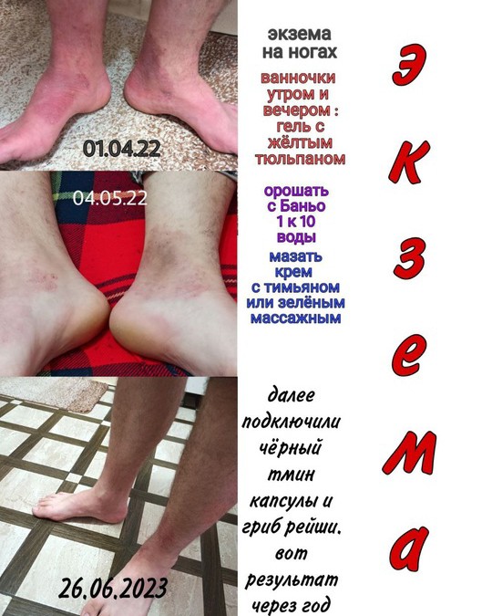 Леся в LOOKY — 🟣Отзыв нашего партнёра 🟣 У сына была экзема на ногах. За г