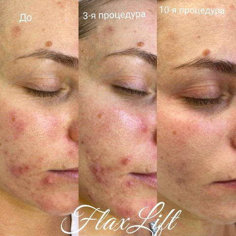 Kosmetik_flaxtap в LOOKY. #flaxliftkostroma#флакслифт#FlaxLift. #flaxliftkostroma#фл...
