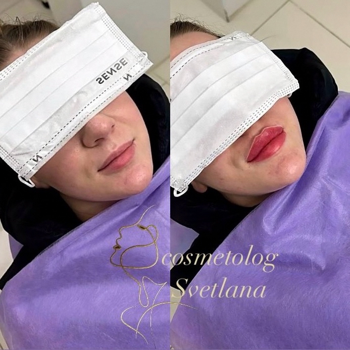Губки До- после выведения старого филлера, который был за контуром красной каймы и в слизистом слое.💉👄
Сразу После 1мл.препарата, создали вот такую красоту❤️
Контурная пластика губ поможет вам:
👄 увеличить объём
👄 изменить форму 
👄 подчеркнуть контур или скорректировать асимметрию 
Результаты контурной пластики:
✔️ вы получите ту форму губ, которую желаете 
✔️ тонкие губы станут более полными и сексуальными
✔️ контур губ станет более четким

☝️Процедура увеличения губ не требует особой подготовки и длится около 30-40 минут.

☝️Увеличение губ производится с помощью инъекций препаратов на основе гиалуроновой кислоты. Которую должен выполнять только ВРАЧ- косметолог!!! 

☝️Все препараты для увеличения объёма губ представляют собой прозрачный вязко-упругий гель, который при введение под кожу абсолютно незаметен.

👄 Губы после контурной пластики выглядят естественно, а их форма и объём сохраняется в течение нескольких месяцев.

😉 Перед проведением процедуры наносится анестезирующий крем, поэтому инъекции практически безболезненны и хорошо переносятся пациентом.

_______________________________

🫦 𝓴𝓸𝓼𝓶𝓮𝓽𝓸𝓵𝓸𝓰 𝓢𝓿𝓮𝓽𝓵𝓪𝓷𝓪 𝓖𝓸𝓻𝓲𝓪𝓮𝓿𝓪 🫦

#косметологснежинск #косметологчелябинск #красота #услугикосметолога #снежинск #челябинск #увеличениегуб #увеличениегубчелябинск #увеличениегубснежинск #услугикосметологачелябинск #услугикосметологаснежинск  #губкибантиком #губыГоряева #губычелябинск #губыснежинск #губыГоряевой #увеличениегубчелябинск #увеличениегубснежинск #косметологиячелябинск #косметологияснежинск #врачкосметолог #врачкосметологчелябинск #врачкосметологснежинск #врачкосметолог #плоскиегубы #красивыегубы #коррекциягуб #выведениегуб #удалениестарогофиллера #удалениестарогофиллераЧелябинск #удалениестарогофиллераСнежинск #выведениегубЧелябинск #выведениегубСнежинск #красивоеувеличениегуб #красивыегубы