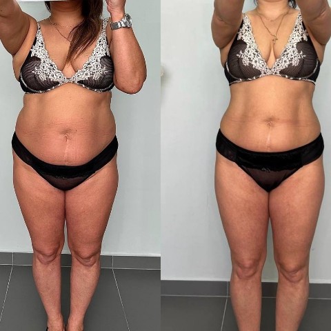 Kosmetik_flaxtap в LOOKY. #худеемдома#худеембездиет#FlaxBody. Холодные обертывания...