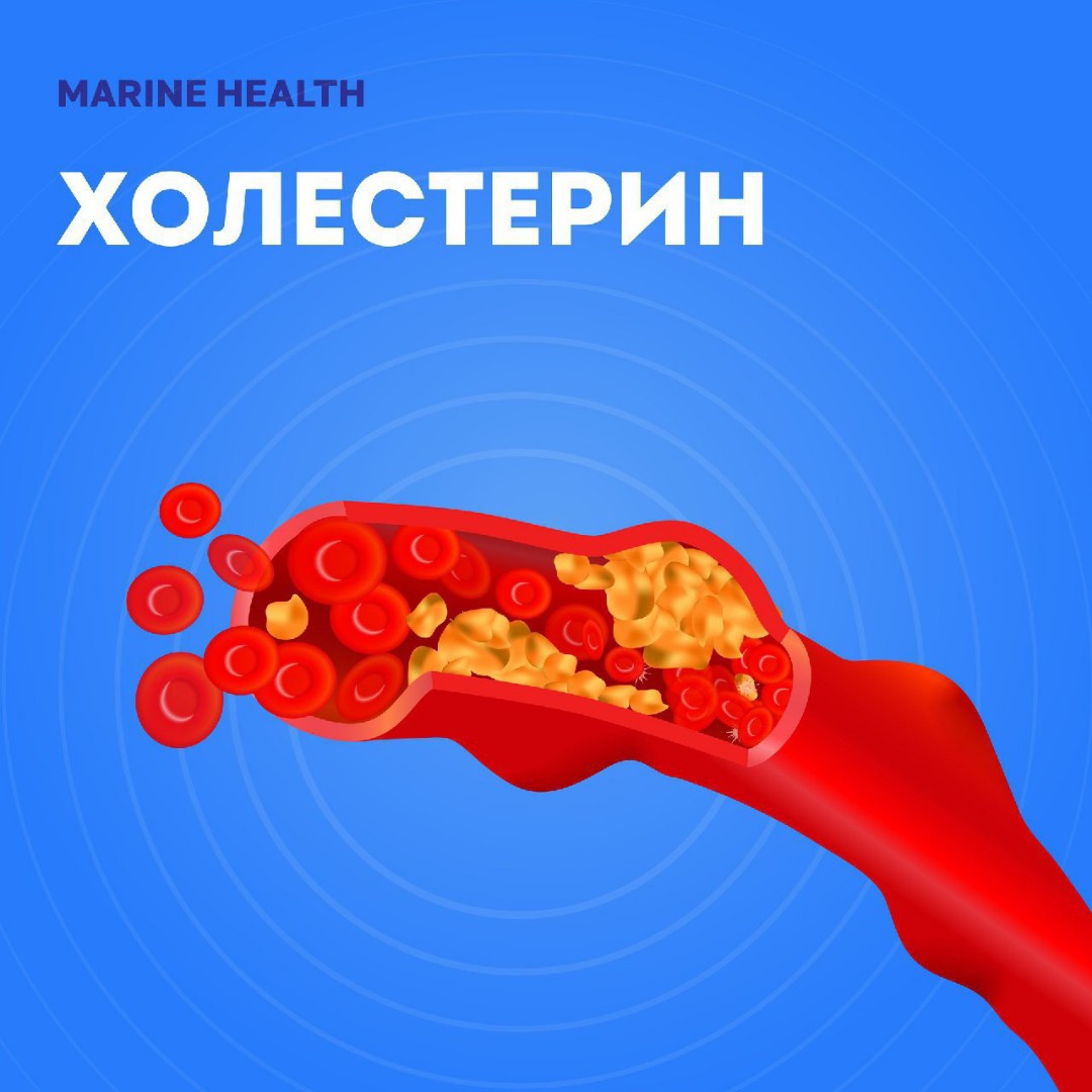 Холестерин!
❓А весь ли #холестерин страшный?

Нет! Только холестерин НИЗКОЙ ПЛОТНОСТИ. Тот самый ЛПНП- холестериновый комплекс, где много жира и мало белка. Он как конфетка с тонким фантиком.

Причины повышения такого холестерина:
🟣Много трансжиров в рационе. Трансжиры это маргарин, фастфуд, жаренные на подсолнечном масле котлеты, кондитерская выпечка, печенье из магазина, сухие завтраки.
Трансжиры не способны формировать качественную связи с белком, поэтому превращаются в ЛПНП («плохой» холестерин) .
🟣Много фруктов в рационе. Фруктоза в печени превращается в триглицериды («плохой» холестерин) .
🟣Дефицит энергии в кишечной стенке. Именно там жировая «конфета» упаковывается в белковый фантик. И для этого нужна #энергия и #БЕЛОК.

Отсюда следующие пункты:
🟣Дефицит белка по разным причинам:
- недостаток в рационе;
- нарушение переваривания на уровне желудка;
- активность патогенной протеолитической (кушающей белок) флоры в кишечнике;
- паразитоз.
🟣Патологии печени. ЛПНП синтезируются и там тоже.
🟣Патологии лимфы. В застойной лимфе жиры могут трансформироваться в ЛПНП.

У тучных людей как правило много ЛПНП. Они откладываются в сосудах, жировой клетчатке, и печени.

Но бывают ситуации, когда жировой гепатоз случается у худых. ПОЧЕМУ?

Потому что печень таким образом стремится справиться с интоксикацией, растворив токсины в жиру. Поэтому ещё одна причина высокого холестерина:
🟣Хроническая #интоксикация!
#marinehealth #токсины #печень #жировойгепатоз #лимфа #кишечник #жизнь #здоровье #москва #спб #приморск #сахалин #тюмень #оренбург #уфа #магнитогорск #новосибирск #новокузнецк #иркутск #минск #екатеринбург #волгоград #вологда #казань #томск #тамбов