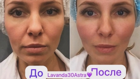 lavanda_30_astra в LOOKY. . RF-лифтинг лица