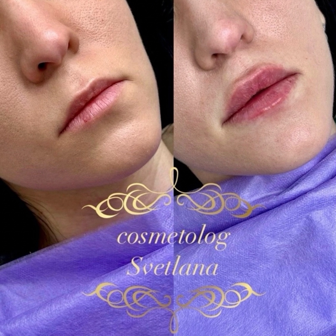 Врач-косметолог в LOOKY — Наши #зажившие_губки_Svetlana_G и после новой процедуры, нем