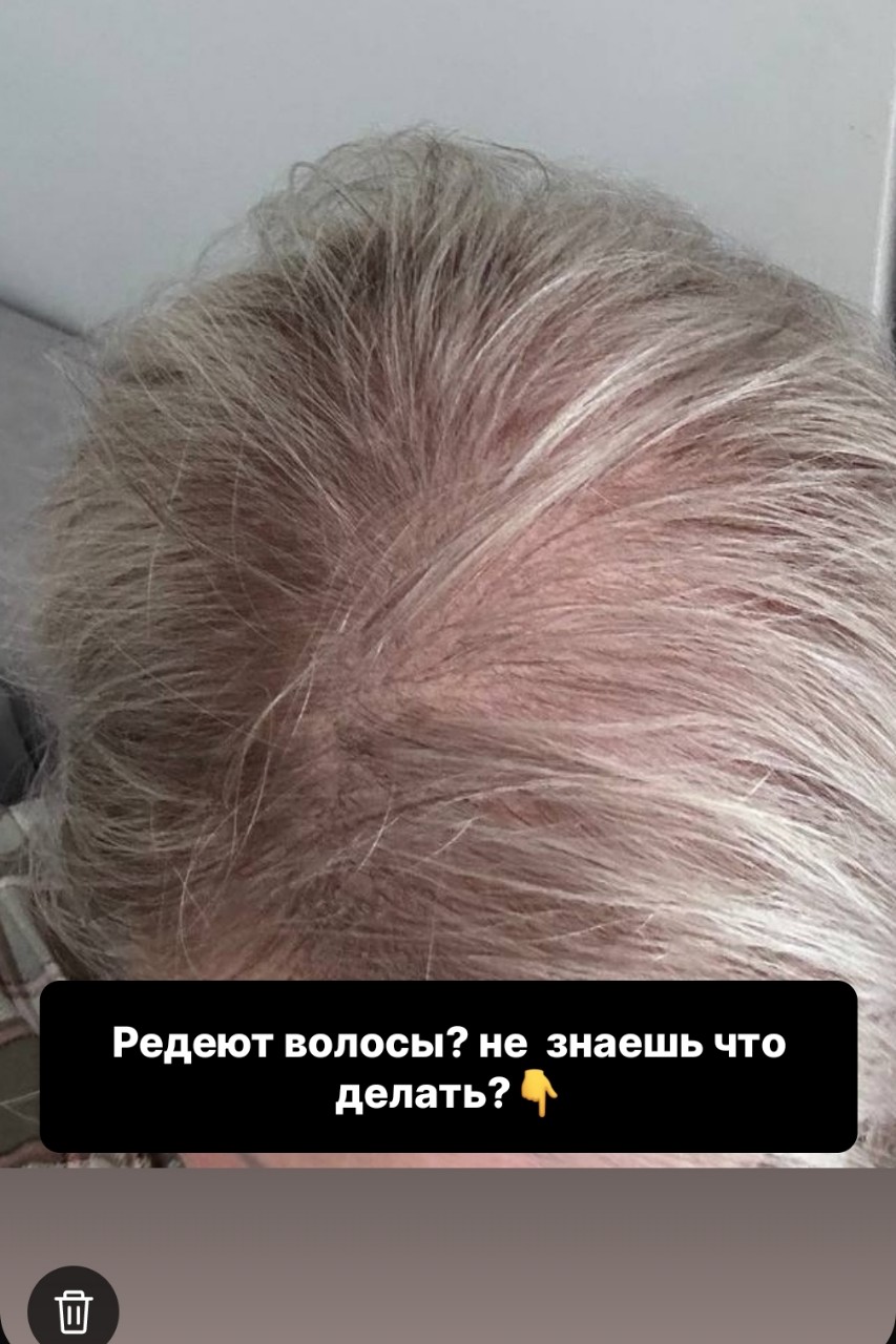 Фото реальное, публикую с письменного  разрешения.

«Это не «просто выпадает» ☝🏻

Если вы видите, что пробор на затылке стал шире, чем на макушке — это уже повод задуматься 🤔
Посмотрите на это фото 👆

Нет, это не последствия ковида.
Не «сезонный линь».
И уже не «просто стресс на работе».

❌ Это то, что продолжается годами.
❌ Само НЕ проходит.
❌ И с каждым годом становится только реже и реже.

Давайте честно. Чего вы боитесь на самом деле, глядя в зеркало?

❌ Боитесь не самих волос.
Боитесь, что однажды кто-то скажет: «А у тебя тут... просвечивает».

❌ Боитесь мыть голову — потому что на руках остаются пучки.

❌ Боитесь ветра — он обнажает пробор.

❌ И самый главный страх:
«Это же генетика. Ничего не поможет».

У вас не «облысение».
У вас андрогенная алопеция (АГА).
Это не болезнь волос.
Это болезнь фолликулов, которая решила, что им пора «спать» из-за чувствительности к гормону.

Что вас беспокоит больше всего?
• Шевелюра редеет по мужскому типу
(да, девушки, у вас тоже так бывает — страдает центральный пробор).
• Новые волосы растут тонкими, как пушок, и сразу выпадают короткими.

• Все шампуни и средства «от выпадения» — не помогают. Деньги на ветер 💸

Здесь и сейчас я развею ваш главный миф про безнадежность.
🔬 Надежда есть. И она научная.
Андрогенная алопеция — это НЕ приговор.
Мы не «вырастим джунгли за 2 недели», но мы остановим поезд 🚂 в 2 клика:

1️⃣ Блокируем чувствительность к ДГТ (того самого убийцу фолликулов) — локально или системно.
Есть препараты с доказанной базой, которые работают десятилетия.

2️⃣ Пробуждаем «спящие» луковицы.

3️⃣ Даём результат через 6–8 месяцев.
Да, АГА не любит спешки — но любит дисциплину.

Теперь к суровой правде ⚠️
Ваша ошибка №1 — купить миноксидил в аптеке по совету блогера
или пропивать все известные и неизвестные витамины.

Поэтому я даю вам не чудо-таблетку.
Я даю вам план 📝
🧬 Спящий фолликул — мы разбудим.
😭 Мёртвый — увы, только трансплантация.

Не упустите момент.

💬 Пишите в комментариях «хочу консультацию»
Я напишу вам в личные сообщения.

Внимание: пост носит информационный характер. 
#андрогеннаяалопеция #ага #выпадениеволос #трихолог #трихологонлайн
